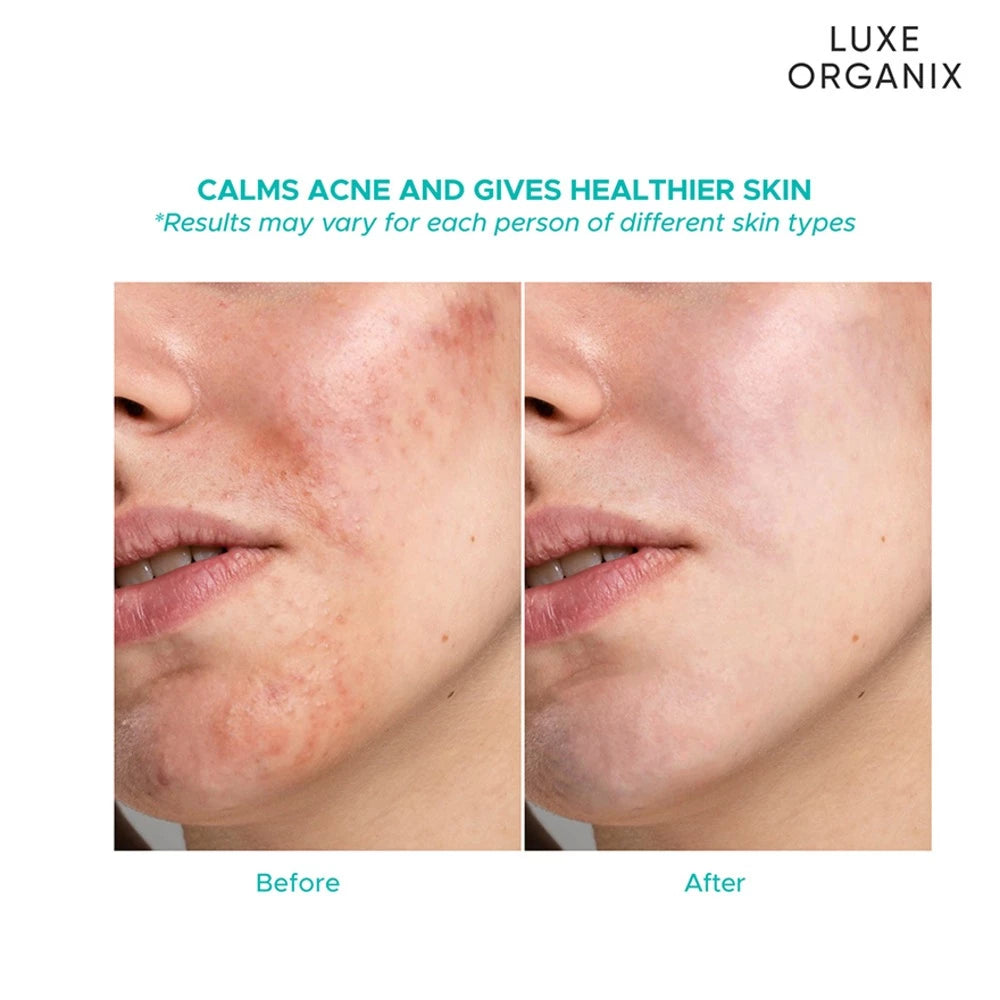 Luxe Organix Miracle Solutions AHA/BHA Acne Derm+ Emulsion 80ml