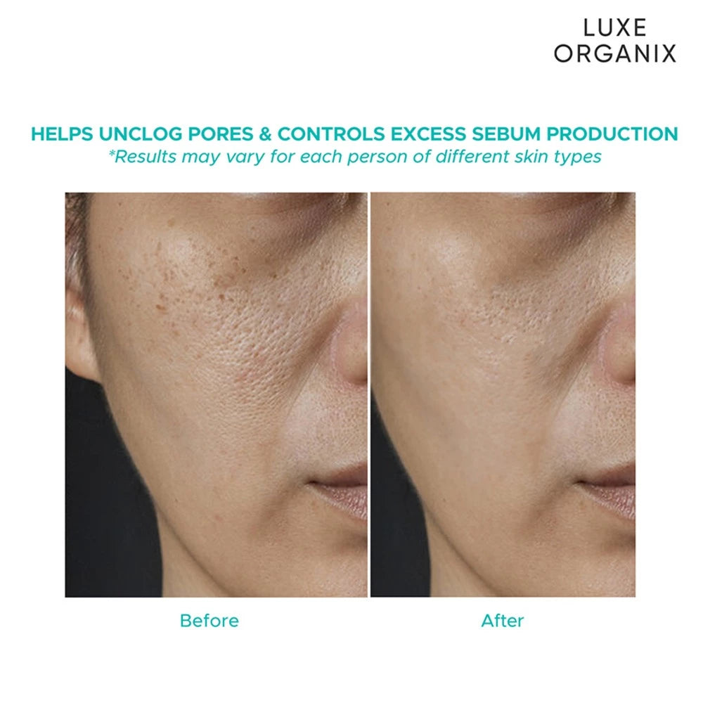 Luxe Organix Miracle Solutions Acne Derm + Serum 7ml