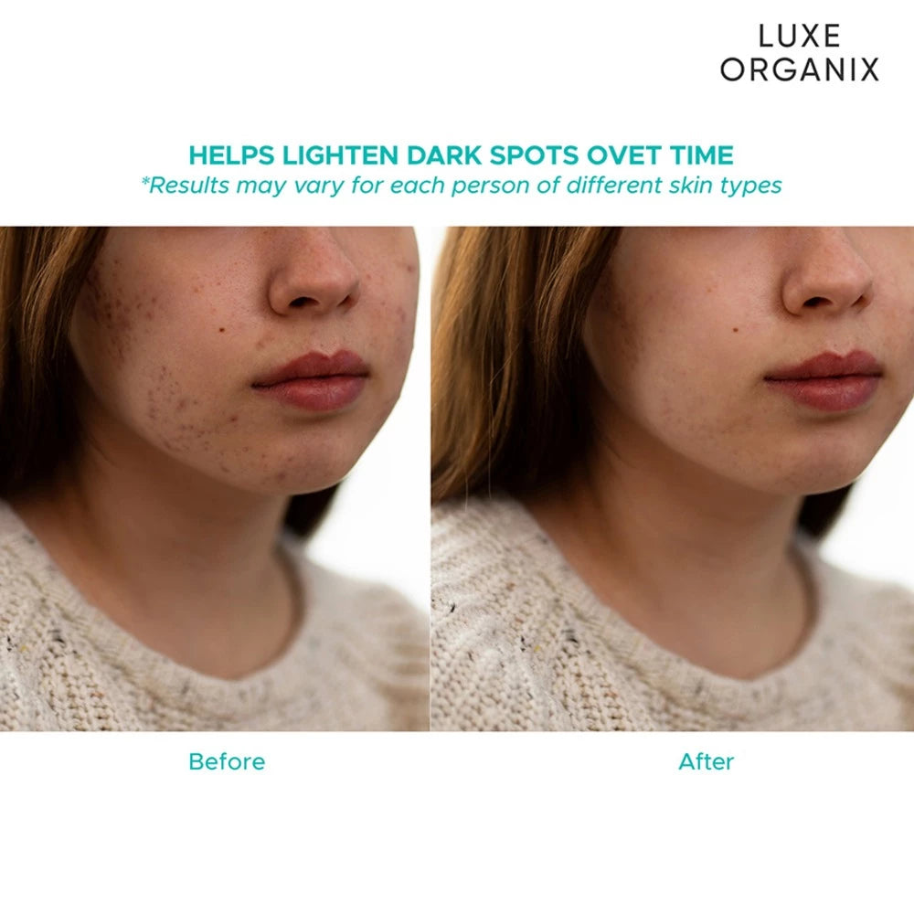 Luxe Organix Miracle Solutions Acne Derm+ Tencel Sheet Mask 25g